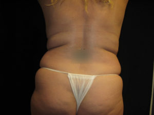 Liposuction Before and After Pictures Glastonbury, CT