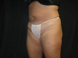 Liposuction Before and After Pictures Glastonbury, CT