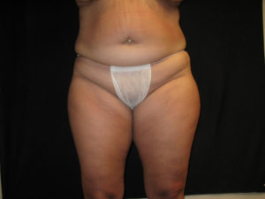 Liposuction Before and After Pictures Glastonbury, CT