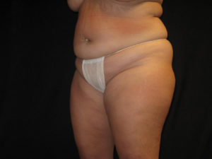 Liposuction Before and After Pictures Glastonbury, CT