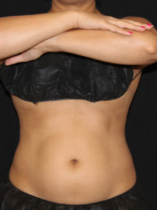 CoolSculpting® Before and After Pictures Glastonbury, CT