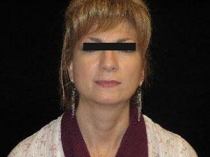 Otoplasty Before and After Pictures Glastonbury, CT
