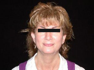 Otoplasty Before and After Pictures Glastonbury, CT