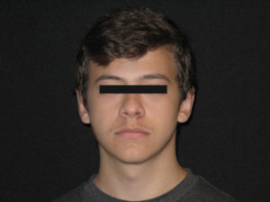 Otoplasty Before and After Pictures Glastonbury, CT
