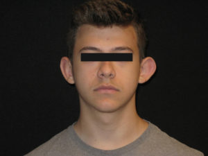 Otoplasty Before and After Pictures Glastonbury, CT