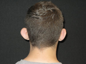 Otoplasty Before and After Pictures Glastonbury, CT