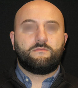 Rhinoplasty Before and After Pictures Glastonbury, CT