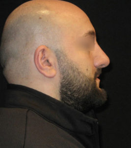 Rhinoplasty Before and After Pictures Glastonbury, CT