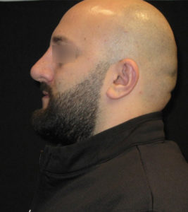 Rhinoplasty Before and After Pictures Glastonbury, CT