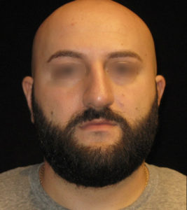 Rhinoplasty Before and After Pictures Glastonbury, CT