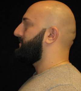 Rhinoplasty Before and After Pictures Glastonbury, CT