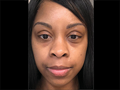 iS Clinical Prodigy Peel Before and After Images in Glastonbury, CT