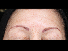 iS Clinical Prodigy Peel Before and After Images in Glastonbury, CT