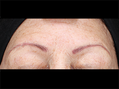 iS Clinical Prodigy Peel Before and After Images in Glastonbury, CT