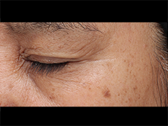 iS Clinical Prodigy Peel Before and After Images in Glastonbury, CT