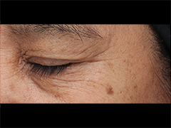 iS Clinical Prodigy Peel Before and After Images in Glastonbury, CT