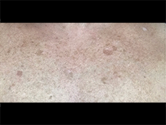 iS Clinical Prodigy Peel Before and After Images in Glastonbury, CT