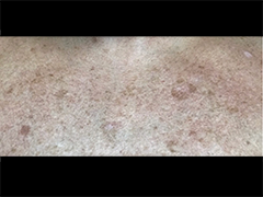 iS Clinical Prodigy Peel Before and After Images in Glastonbury, CT