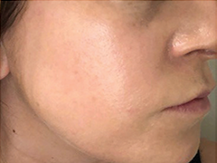 iS Clinical Prodigy Peel Before and After Images in Glastonbury, CT