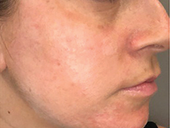 iS Clinical Prodigy Peel Before and After Images in Glastonbury, CT
