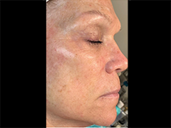 iS Clinical Prodigy Peel Before and After Images in Glastonbury, CT