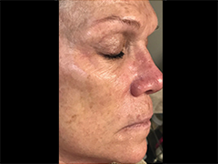 iS Clinical Prodigy Peel Before and After Images in Glastonbury, CT