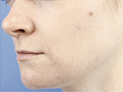 iS Clinical Prodigy Peel Before and After Images in Glastonbury, CT