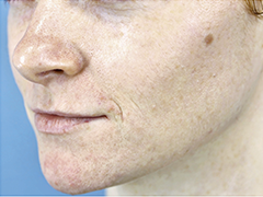 iS Clinical Prodigy Peel Before and After Images in Glastonbury, CT