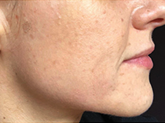 iS Clinical Prodigy Peel Before and After Images in Glastonbury, CT