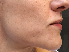iS Clinical Prodigy Peel Before and After Images in Glastonbury, CT