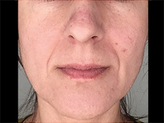 iS Clinical Prodigy Peel Before and After Images in Glastonbury, CT