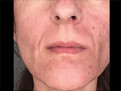 iS Clinical Prodigy Peel Before and After Images in Glastonbury, CT